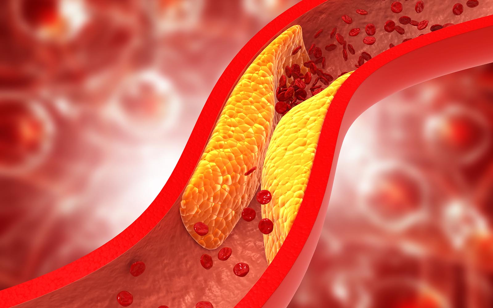 Arteriosklerose Symptome - Hauptursache der koronaren Herzkrankheit