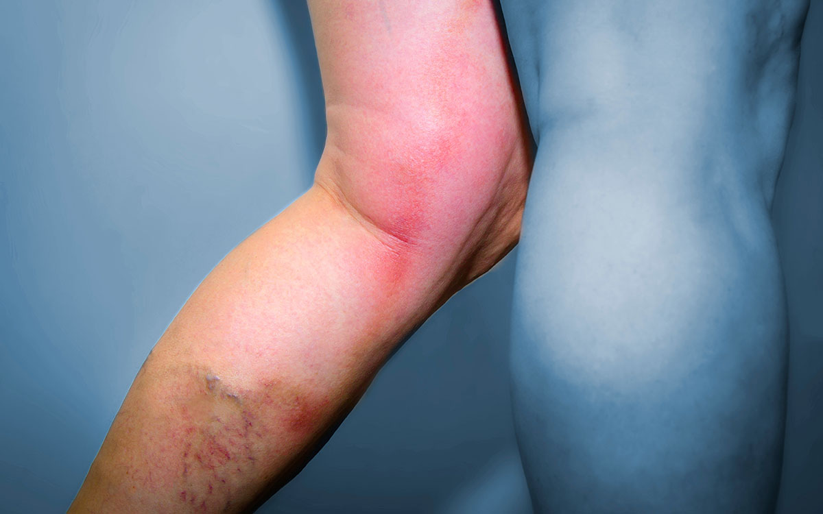 Tiefe Venenthrombose (TVT): Symptome, Behandlung und Vorbeugung