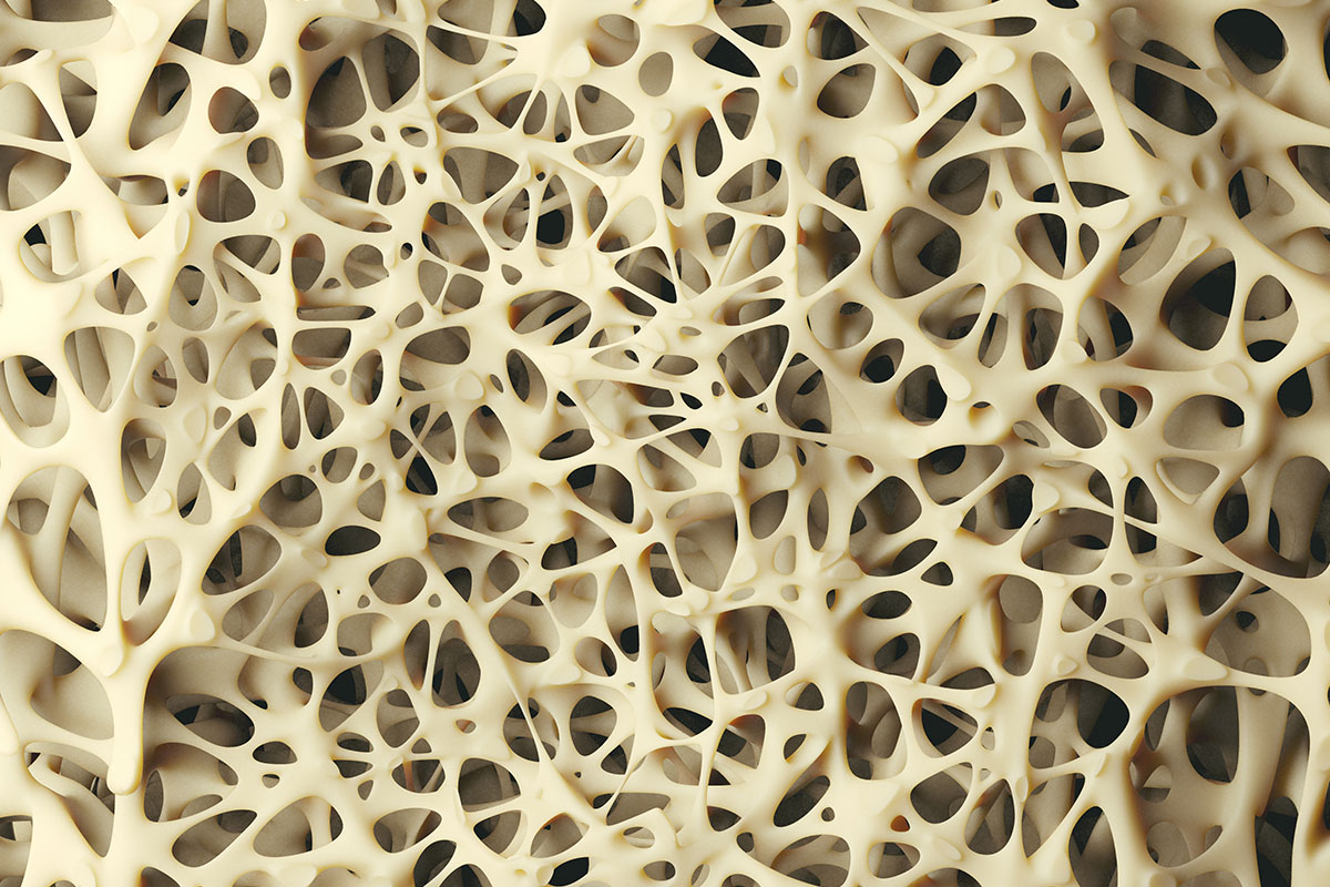 Vitamin D Mangel kann Calcium Mangel auslösen - Wie Sie beides vermeiden